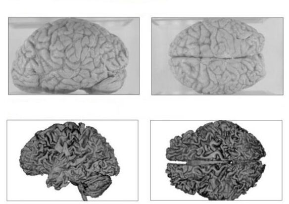 O cérebro de uma pessoa saudável (acima) e o cérebro de um alcoólatra com consequências irreversíveis (abaixo)
