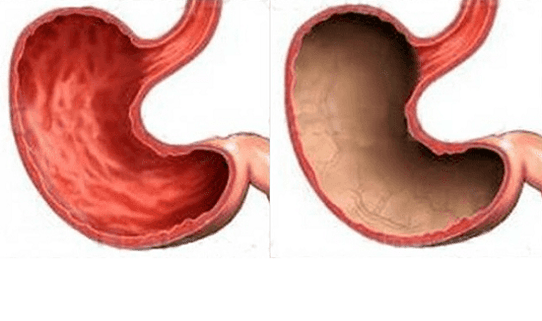 Úlcera, gastrite, câncer e outras patologias do estômago (à direita), cuja aparência foi causada pelo álcool